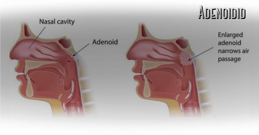 Adenoidid